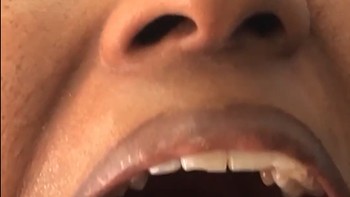 Hyperdontia adalah suatu kondisi dimana gigi tambahan tumbuh di dalam mulut, biasanya di lokasi di belakang atau dekat gigi sulung atau gigi permanen biasa. Ini dialami Kalpana Balan dari India. Dia punya 38 gigim menjadinya perempuan yang memiliki gigi di dunia. Foto: Brightside