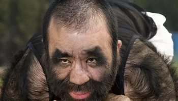 Sejak usia 2 tahun, Yu Zhenhuan menderita penyakit langka yang mengakibatkan 96% tubuhnya ditutupi rambut, menjadikannya pria paling berbulu di dunia. Foto: Brightside
