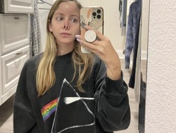 Hidung Wanita Digigit Anjing, Begini Bentuknya Setelah 10 Kali Operasi Plastik