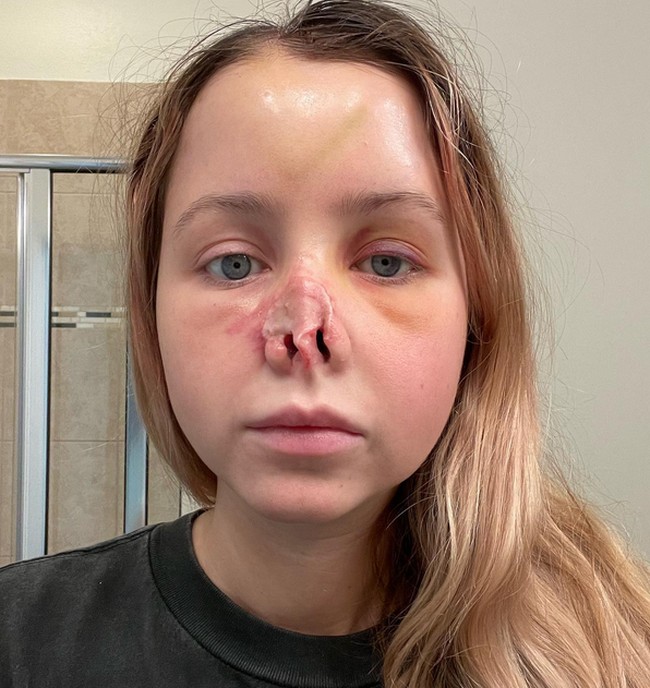 Jordan Wilson mengalami tragedi diserang anjing pada 2022. Hidungnya tercabik hingga membutuhkan penanganan khusus. Foto: dok. Instagram/sincerelyjord