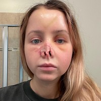 Jordan Wilson mengalami tragedi diserang anjing pada 2022. Hidungnya tercabik hingga membutuhkan penanganan khusus. Foto: dok. Instagram/sincerelyjord