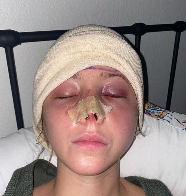 Menurut TikTok Jordan, pada Juli 2023, dia telah menjalani 10 operasi rekonstruksi. Saat ini hidungnya belum kembali normal.  Foto: dok. Instagram/sincerelyjord