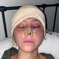 Menurut TikTok Jordan, pada Juli 2023, dia telah menjalani 10 operasi rekonstruksi. Saat ini hidungnya belum kembali normal.  Foto: dok. Instagram/sincerelyjord