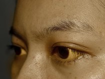 Asal Konsumsi Obat Herbal, Tubuh Wanita Ini Menguning Seperti Karakter Simpson