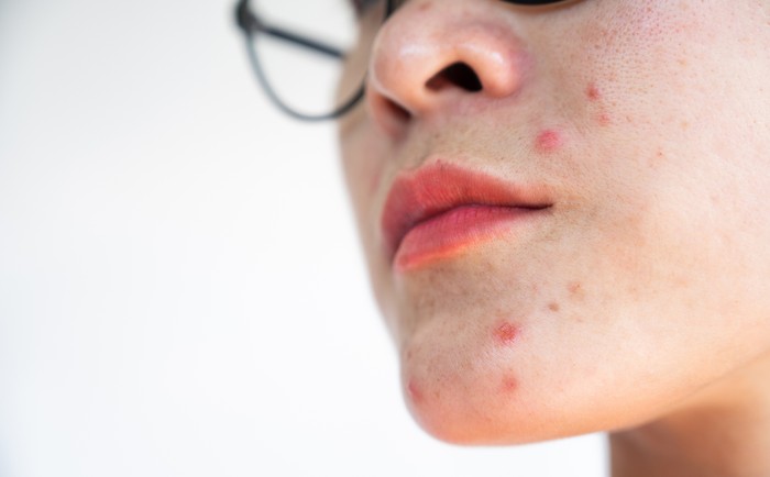 Jerawat di Atas Bibir