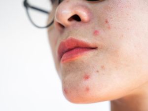Arti Jerawat di Atas Bibir yang Jangan Diabaikan, sedang Stres?