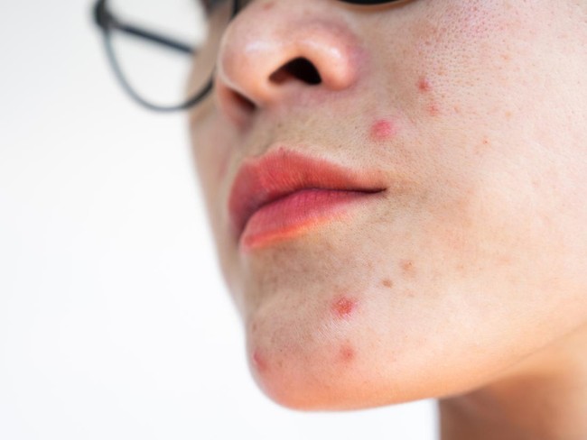 Jerawat di Atas Bibir