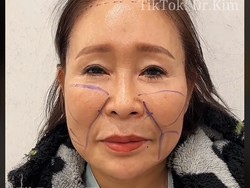 Transformasi Oplas Viral, Nenek-nenek Jadi Wanita Muda dalam Seminggu