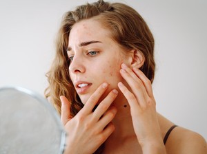 6 Letak Jerawat dan Penyebabnya, Hati-hati Jika Muncul di Hidung