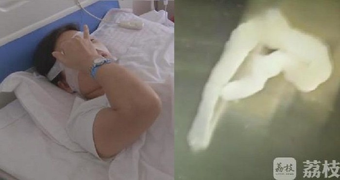 Seram! Sering Makan Daging Hewan Mentah, 5 Orang Ini Tubuhnya Dipenuhi Cacing Pita