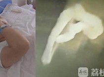 Seram! Sering Makan Daging Hewan Mentah, 5 Orang Ini Tubuhnya Dipenuhi Cacing Pita