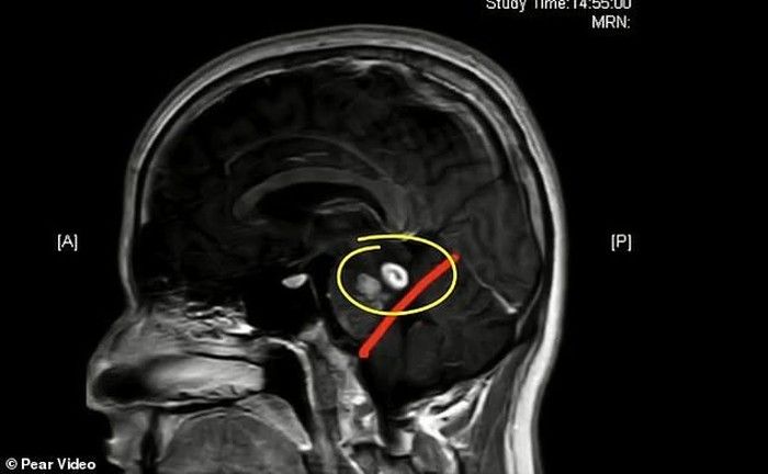 Kengerian!  Kerap Makan Daging Hewan Mentah, 5 Orang Ini Punya Tubuh Penuh Cacing Pita