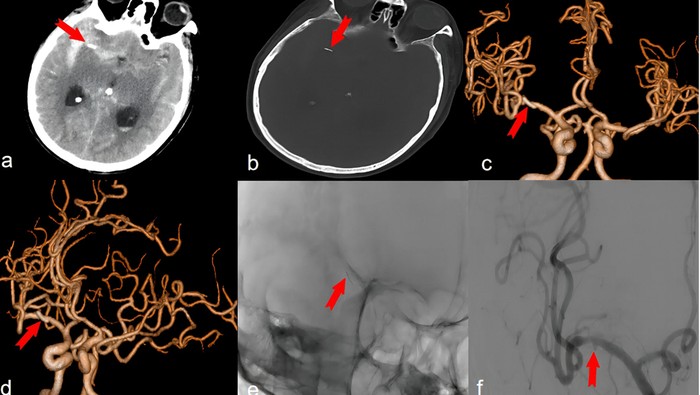 Penampakan Jarum Akupunktur Nyangkut di Otak, Diduga Sudah Ada Selama 20 Tahun