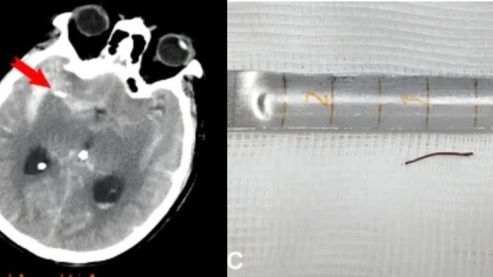 Ngeri, Dokter Temukan Jarum Akupunktur yang Tertancap di Otak Pria 74 Tahun