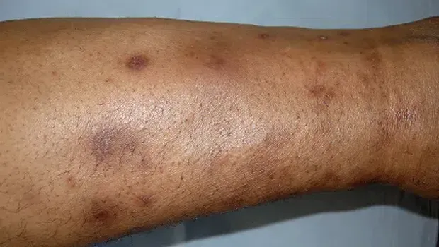 Tanda pada kulit jika terkena diabetes. (Dok. https://www.aad.org/)