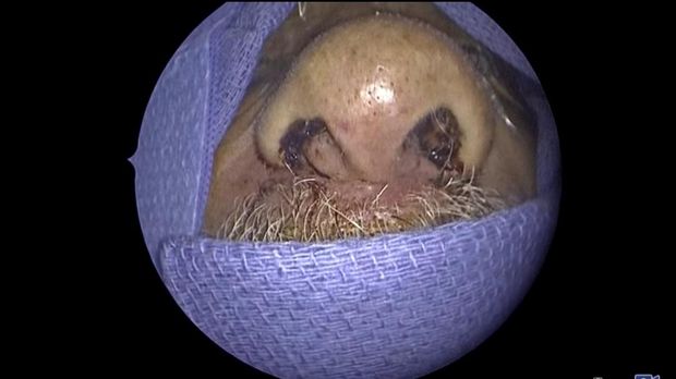 Dokter temukan ratusan serangga dan larva yang hidup di dalam hidung.