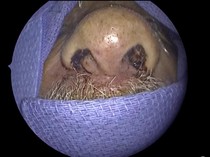 Merinding! Kisah Pria Sulit Napas gegara 150 Serangga Bersarang di Hidung