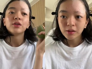 Heboh Pengakuan Wanita Jakbar, Efek Bleaching Rambut Betulan Picu Vitiligo?