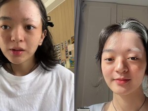 Ramai Wanita DKI Kena Vitiligo usai Bleaching, Bisakah Kulit Kembali Seperti Semula?