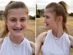 Viral Transformasi Wanita Pascaoperasi Rahang, Manglingi Seperti Beda Orang