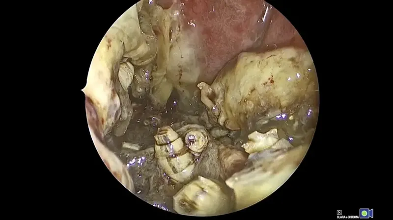 Seorang laki-laki memiliki 150 larva yang hidup di hidungnya. Semua terungkap setelah dia terus mengalami hidung berdarah dan wajah membengkak.