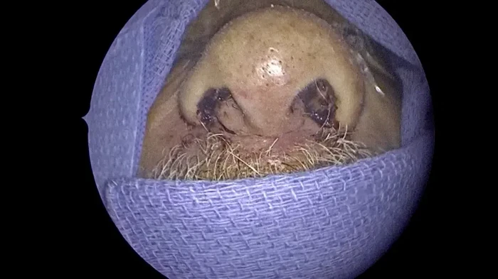 Seorang laki-laki memiliki 150 larva yang hidup di hidungnya. Semua terungkap setelah dia terus mengalami hidung berdarah dan wajah membengkak.