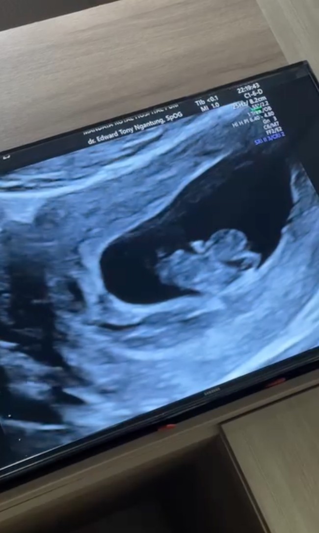 Saat di USG terlihat sang jabang bayi aktif bergerak. Tak sedikit netizen yang mendoakan agar Shanju dan bayi dalam kandungannya selalu sehat hingga proses persalinan nanti. Foto: Instagram/@shanju