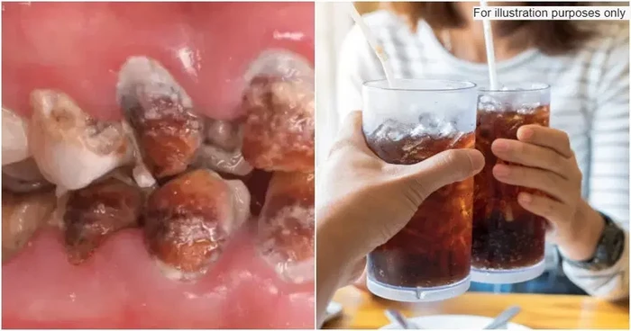 Minum Soda Tiap Hari, Wanita Ini Keluarkan Rp 442 Juta Untuk Obati Giginya