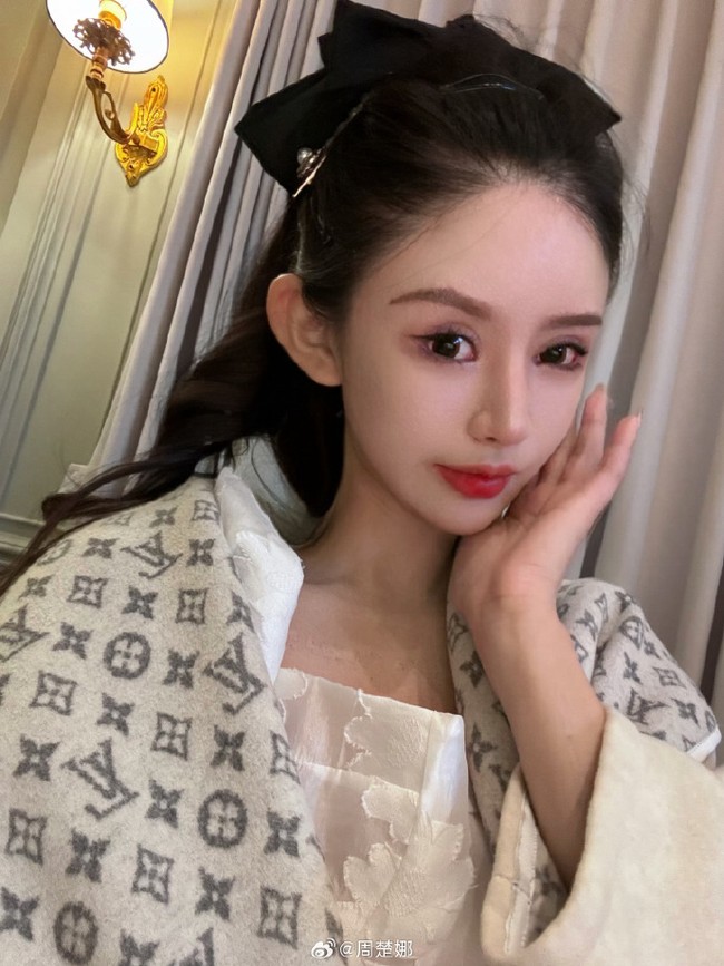 Tekanan lingkungan dan standar kecantikan membuat semakin banyak remaja terobsesi penampilan. Seorang gadis yang dikenal sebagai Nana bahkan disebut sudah melakukan serangkaian operasi di usianya yang baru 18 tahun. Foto: Dok. Weibo