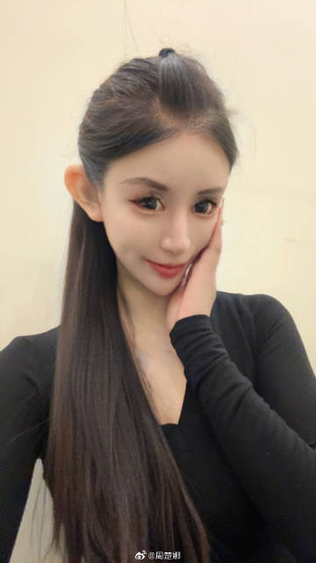 Hingga kini Zhou disebut sudah menjalani lebih dari 100 tindakan untuk mencapai penampilan impian. Dokter pun mewanti-wanti Zhou Chuna agar tidak lagi operasi. Sebelumnya ia bahkan sudah 10 kali melakukan tindakan pada mata tapi masih berniat memperbaiki lagi. Padahal orang-orang wajahnya sudah sangat berubah bahkan tidak mengenali. Foto: Dok. Weibo