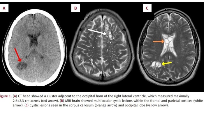 Pria Ini Sampai Migrain 4 Bulan karenanya, Bagaimana Cacing Pita Masuk ke Otak?