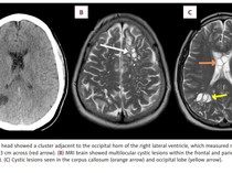 Pria Ini Sampai Migrain 4 Bulan karenanya, Bagaimana Cacing Pita Masuk ke Otak?