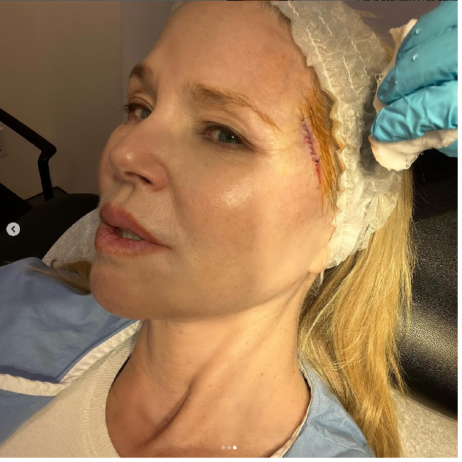 Melalui unggahan di Instagram, model 70 tahun itu memperlihatkan foto yang bagi sebagian orang tak menyenangkan untuk dilihat. Pada foto tersebut tampak ada lubang terbuka dan berdarah di wajah Christie yang terkena kanker. Foto: Dok. Instagram Christie Brinkley