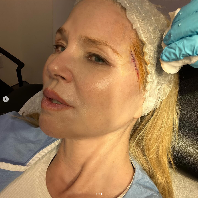 Melalui unggahan di Instagram, model 70 tahun itu memperlihatkan foto yang bagi sebagian orang tak menyenangkan untuk dilihat. Pada foto tersebut tampak ada lubang terbuka dan berdarah di wajah Christie yang terkena kanker. Foto: Dok. Instagram Christie Brinkley