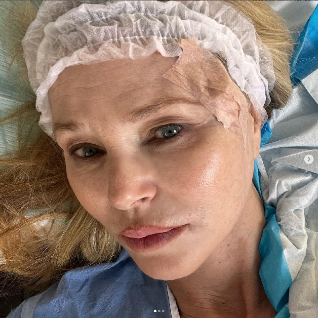 Christie Brinkley memamerkan kondisi wajahnya yang terkena kanker kulit. Dia menjalani operasi setelah dokter menemukan karsinoma sel basal di wajahnya. Foto: Dok. Instagram Christie Brinkley