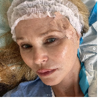 Christie Brinkley memamerkan kondisi wajahnya yang terkena kanker kulit. Dia menjalani operasi setelah dokter menemukan karsinoma sel basal di wajahnya. Foto: Dok. Instagram Christie Brinkley