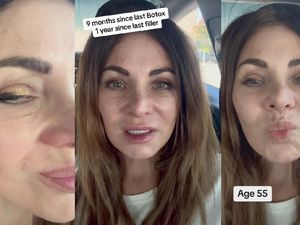 Sempat Viral Efek Wanita Setop Botox Setelah 20 Tahun, Begini Nasibnya Sekarang