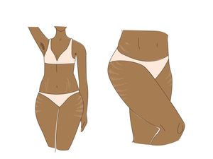 19 Maret Hari Stretch Mark Nasional, Ini Sejarah dan Tujuannya
