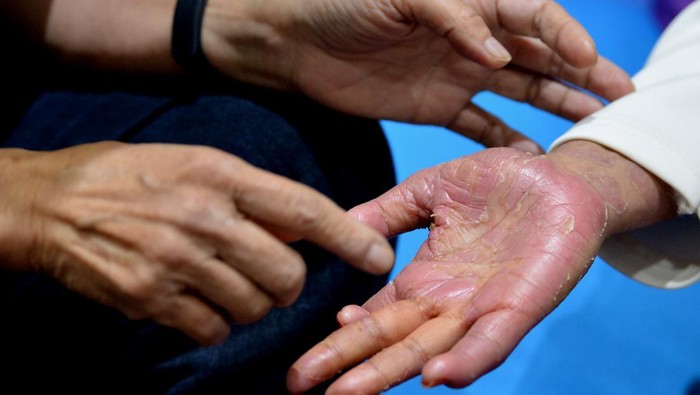 Dokter Spesialis Kulit dan Kelamin berdiskusi dengan pasien pengidap psoriasis (autoimun radang kulit) saat kegiatan bertajuk ERHA Skinability, Pahami Psoriasis di Badung, Bali, Sabtu (16/3/2024). Kelas edukasi tersebut menjadi ajang diskusi secara langsung yang dilakukan oleh 100 penderita psoriasis di Provinsi Bali dengan dokter spesialis kulit dan kelamin ERHA Ultimate yang didukung oleh ERHA Atopy & Skin Disease Center khususnya terkait dengan penanganan kesehatan kulit pasien. ANTARA FOTO/Fikri Yusuf/YU