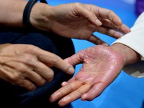 Edukasi Psoriasis untuk Para Penderita di Bali