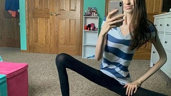 Terobsesi kurus, tapi jadi aneh banget. Foto: Reddit