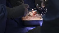 Direktur Pusat Toleranso Transplantasi Klinis Legorreta dan ahli bedah, Tatsuo Kawai, mengatakan organ babi itu memiliki ukuran yang sama persis dengan ginjal manusia. Saat ditransplantasi, ginjal berubah warna menjadi merah muda dan mulai mengeluarkan urine. (Foto: AP/)