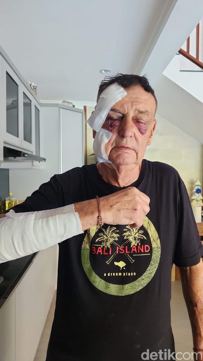 Warga Australia, Graham Murray Leggett, yang diduga mengalami penganiayaan oleh rekan bisnis senegaranya di Bali.