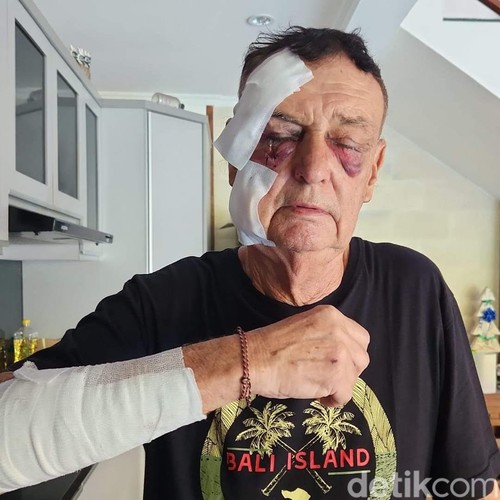 Warga Australia, Graham Murray Leggett, yang diduga mengalami penganiayaan oleh rekan bisnis senegaranya di Bali.