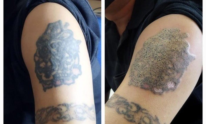 Before-after hapus tato (Kurniawan/detikcom)