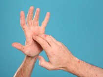 Simak! Cara Pencegahan dan Pengobatan Flu Singapura