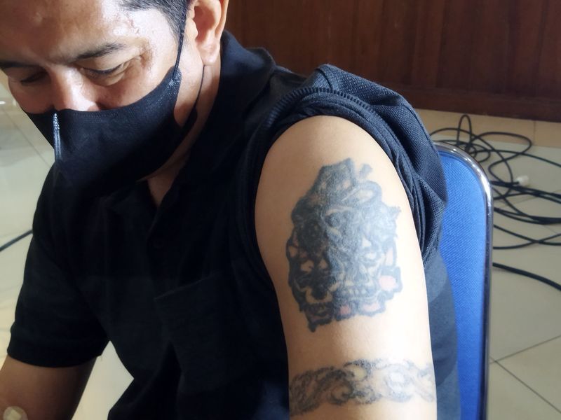 Kondisi lengan Fauzi peserta hapus tato gratis di Jakspus (Kurniawan/detikcom)