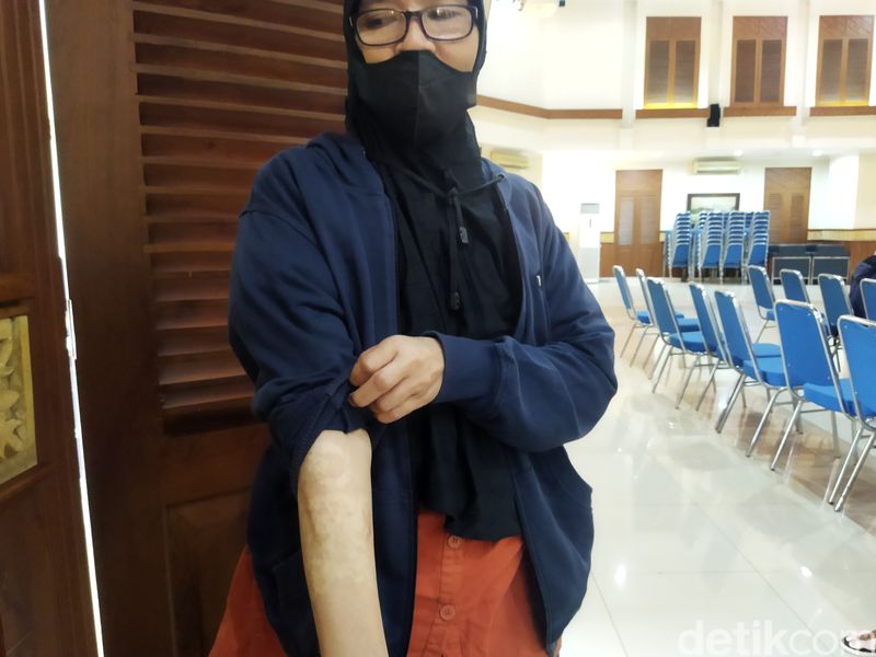Warga antusias mengikuti layanan hapus tato gratis di kantor Wali Kota Jakpus yang diadakan Baznas. (Kurniawan F/detikcom)