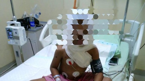 Kondisi korban I Wayan Budiana saat menjalani perawatan di RS Balimed, Karangasem akibat luka bakar, Rabu (27/3/2024). (Istimewa)