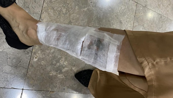 Warga DKI, Nita, menunjukkan kakinya yang baru saja menjalani hapus tato.